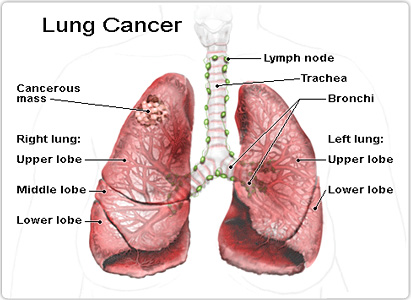 肺癌癥狀